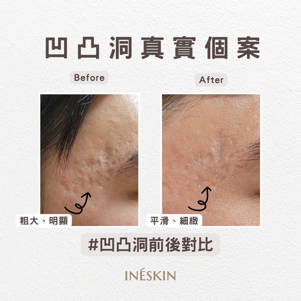 Ineskin