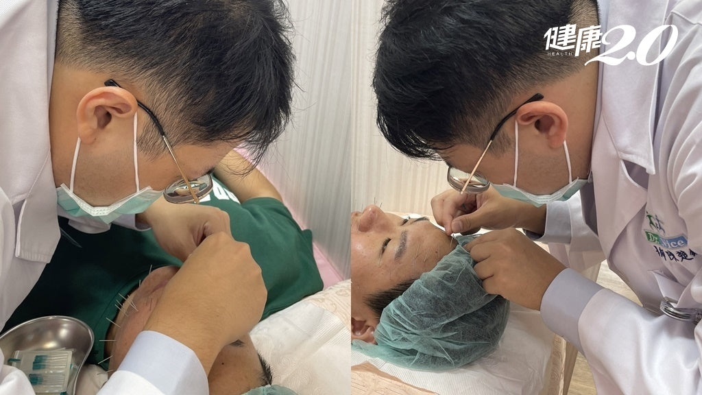 中醫師進行美顏針療程，針灸臉部穴位助淡紋拉提、調理氣血及抗衰老。