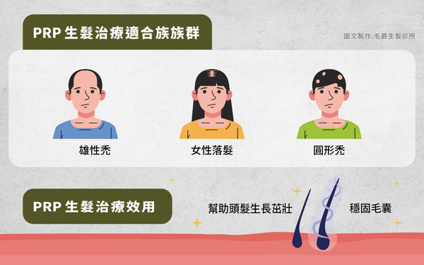 PRP適合族群：雄性禿、女性落髮、圓形禿，圖片來自毛爵生髮診所