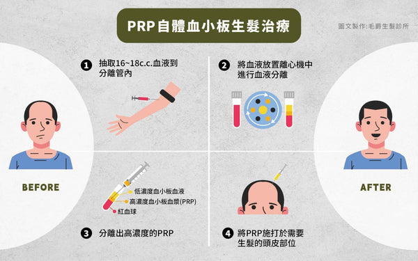 PRP離心分離過程：從全血提取高濃度血小板血漿用於刺激毛囊再生，圖片來自毛爵生髮診所