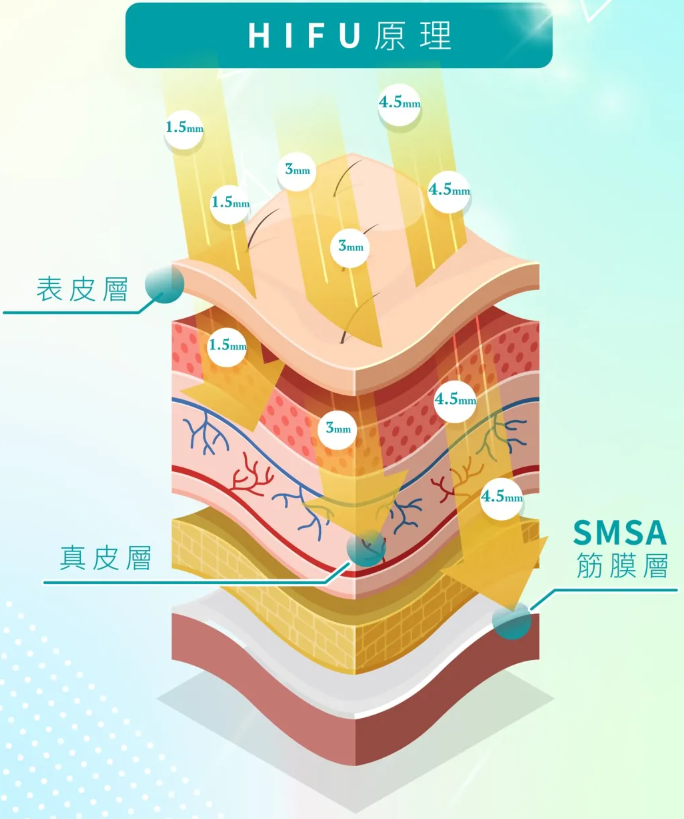 HIFU高強度聚焦超聲波療程示範，刺激4.5mm筋膜層產生新膠原的科學療程過程