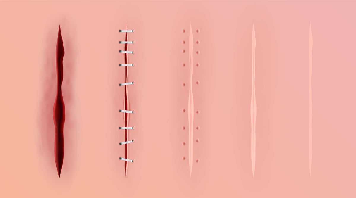 傷口癒合四階段示意圖