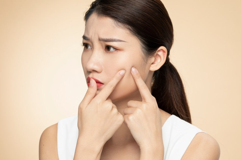 一名亞洲女性正在擠痘痘，受轉季爆痘困擾