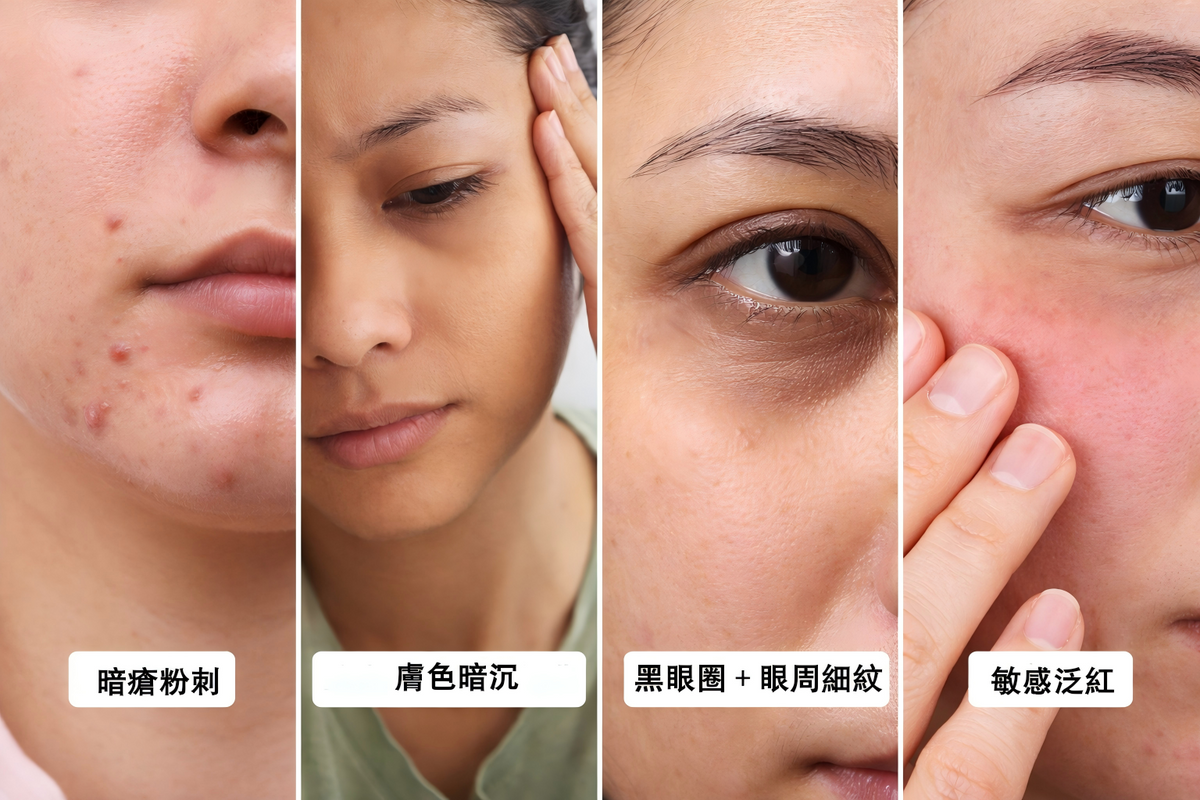 Z世代壓力肌膚問題黑眼圈暗瘡暗沉膚色 tired Asian woman with dark circles acne and dull skin
