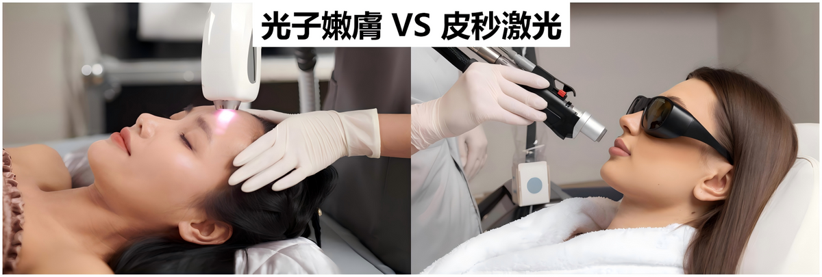 光子嫩膚VS皮秒激光淡斑效果比較 | IPL vs Pico laser pigmentation treatment comparison effectiveness