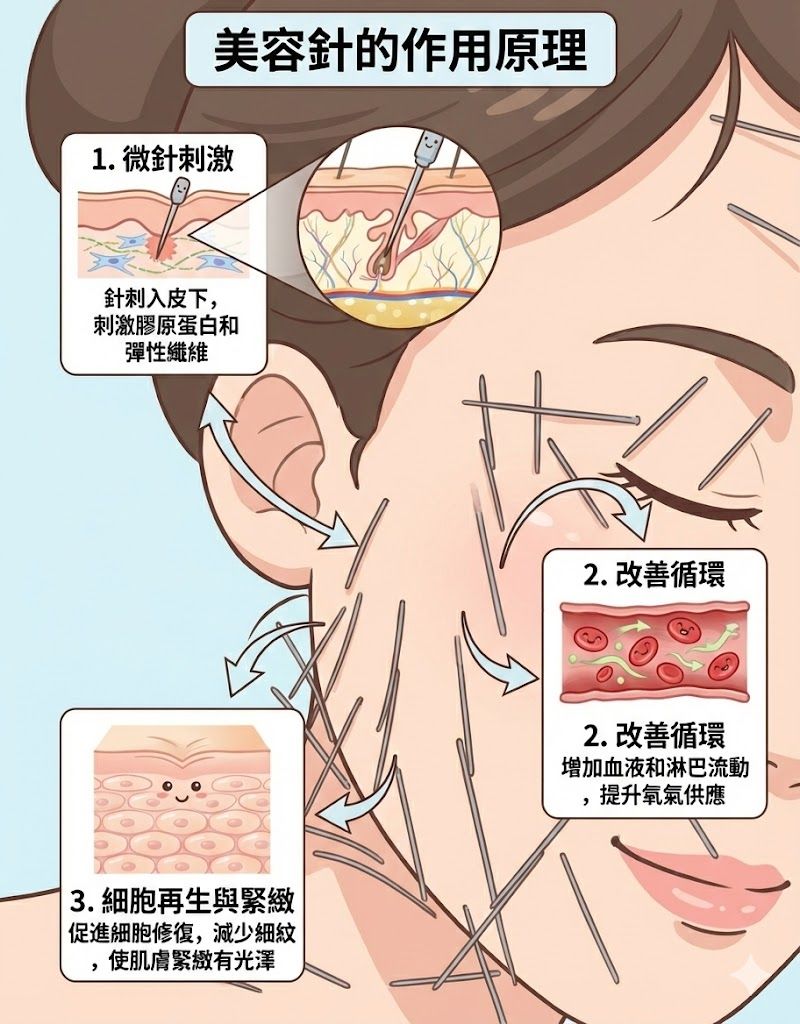 中醫美容針原理示意圖：針雕微針刺激皮下膠原蛋白再生，改善血液循環及臉部拉提，達至緊緻肌膚及抗衰老效果。