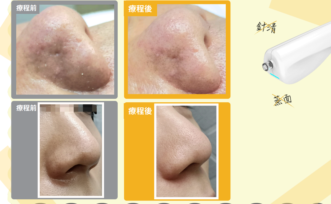 Beauty100-magazine展示GLOW²微米毛孔槍深層清潔療程對比，有效清除黑頭粉刺並細緻毛孔。